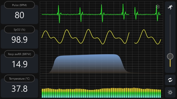 Patient monitor with pulse, SpO2, respiration, and temperature readouts beside green and yellow waveform traces